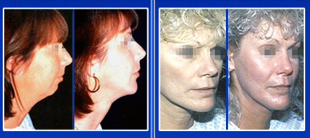 Chin and Cheek Implants in India